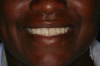 Full mouth reconstruction, smile makeover