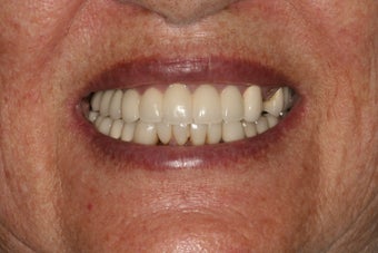 Dental implants and PFM bridge