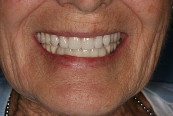 Implant supported overdentures