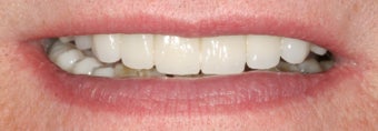 Full mouth reconstruction