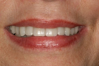 Dental implants, bone grafts, all porcelain crowns 