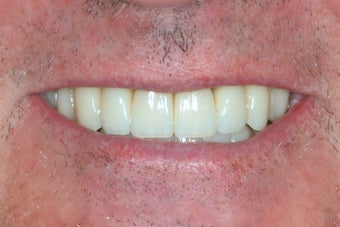 Dental implants, all porcelain restorations