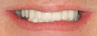 Dental implants, all porcelain crowns