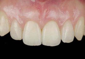 Dental Implants For Missing Front Teeth