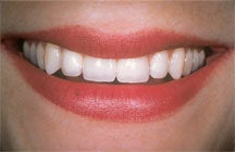 Dental Implant For Missing Front Tooth