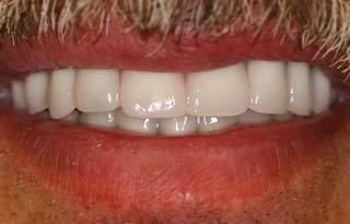 Dental Implants