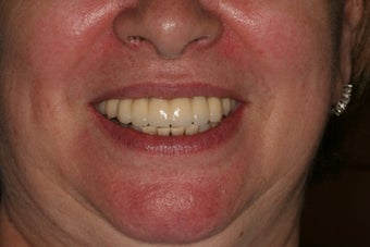 Full Mouth reconstruction, Smile makeover