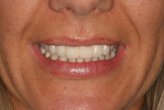 Dental crowns, dental implants, dental veneers