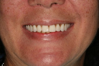 Dental implants, implant overdenture