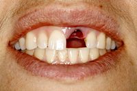 Dental Implants on the front tooth
