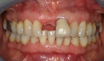 Anterior dental implant