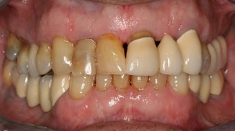 Full mouth reconstruction