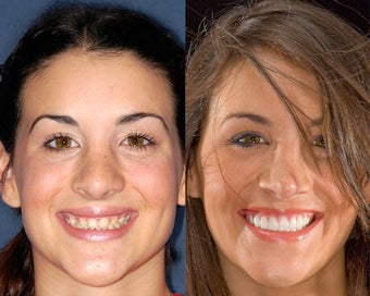 Implants restored with porcelain crowns