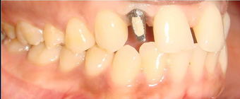 Replacing congenitally missing tooth with Dental Implant