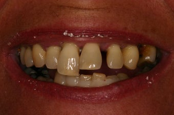 Same day implant supported teeth.