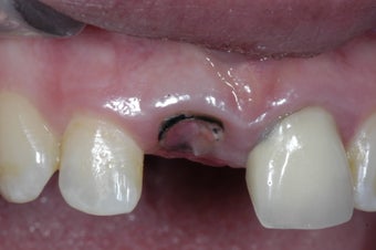 Single implant and crown in smile zone