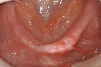 Full mouth dental implants with fixed porcelain bridge