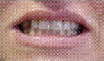 Dental Implant replacing missing canine