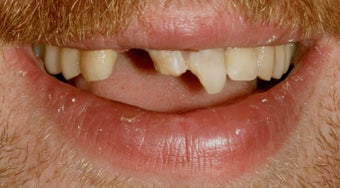 Trauma, Implants, Full Restoration