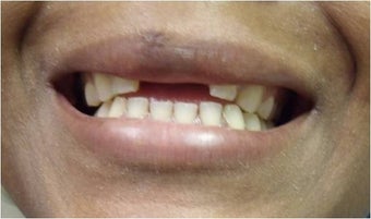 Mini Dental Implants replacing missing front teeth