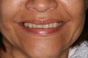Implant restorations of posterior segments on the top and bottom