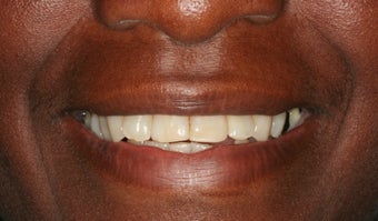 Full mouth reconstruction, smile makeover