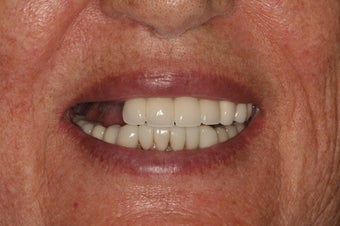 Dental implants and PFM bridge