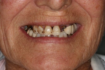 Implant supported overdentures