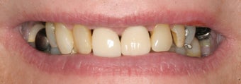 Full mouth reconstruction