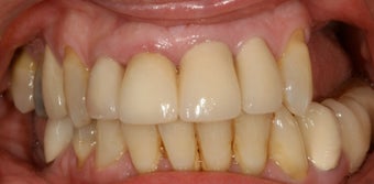 Dental implants, bone grafts, all porcelain crowns 