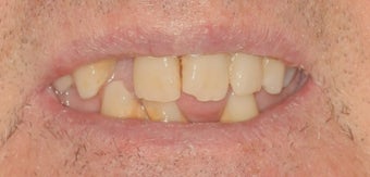 Dental implants, all porcelain restorations