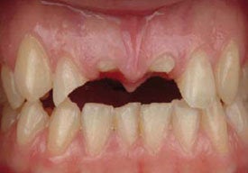 Dental Implants For Missing Front Teeth