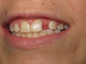 Dental Implant for Missing Lateral Incisor