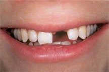 Dental Implant For Missing Front Tooth