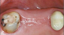 Dental Implants For Missing Back Teeth