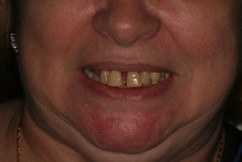 Full Mouth reconstruction, Smile makeover