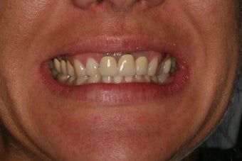 Dental crowns, dental implants, dental veneers