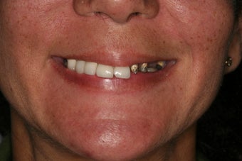 Dental implants, implant overdenture