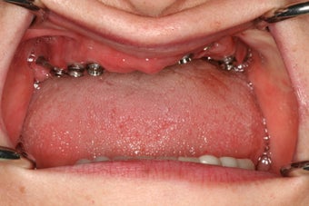 Upper Zirkonia hybrid prosthesis