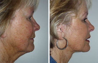 Facelift with dermabrasion