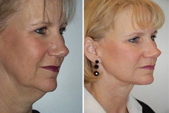 Face lift with dermabrasion 