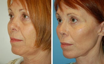 Facelift