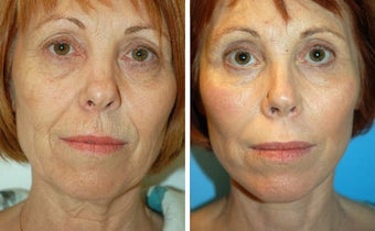 Facelift