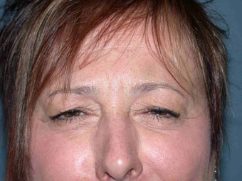 Dysport injections 