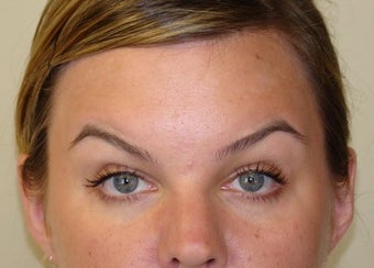 Dysport Injections
