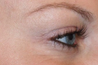 Dysport injections for Crow's Feet