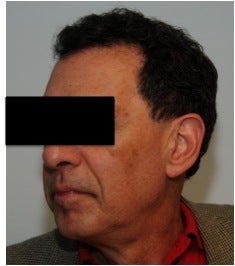 Dysport treatment for Crow's Feet