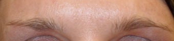 Dysport injections 