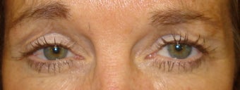 Frown lines treatment