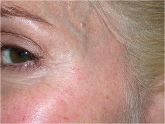 Improvement of crow's feet wrinkles with Dysport